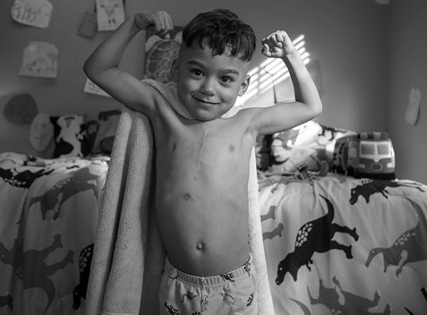 JuJu Rivera, a five-year-old boy from Lebanon who received three heart surgeries at Penn State Children’s Hospital, makes muscles with both arms as he stands in his bedroom. He has a vertical scar on his chest and is wearing a towel on his back like a superhero cape and pajama pants. Behind him, his bed is covered with a bedspread decorated with dinosaurs.